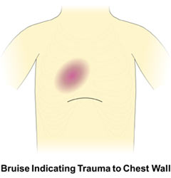 Bruise Indicating Trauma to Chest Wall