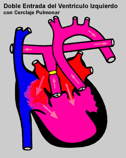 Double Inlet Left Ventricle